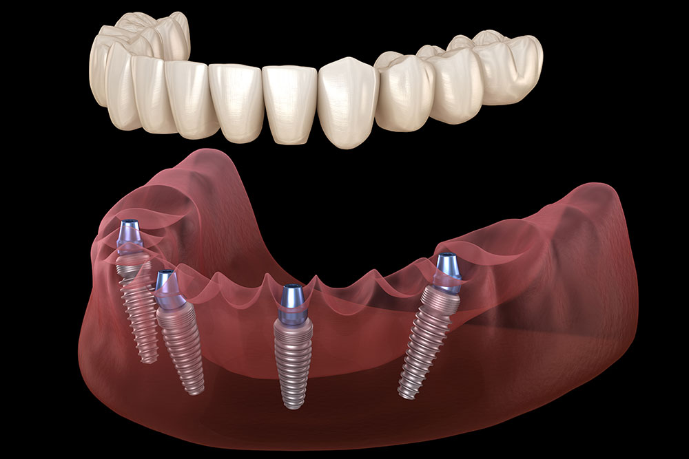 Implant Supported Dentures