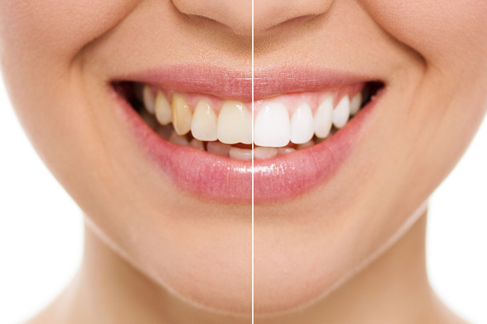 teeth whitening before and after