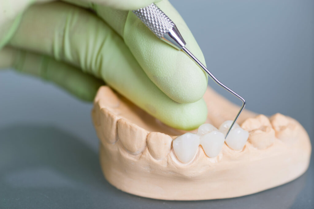 dental bridge modal